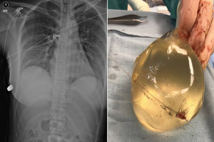 Woman's breast implant deflects bullet, saving life